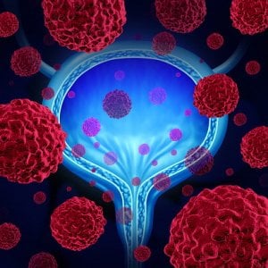 Tumore del rene, nuovi risultati sull’efficacia della combo immunoterapia e terapia target