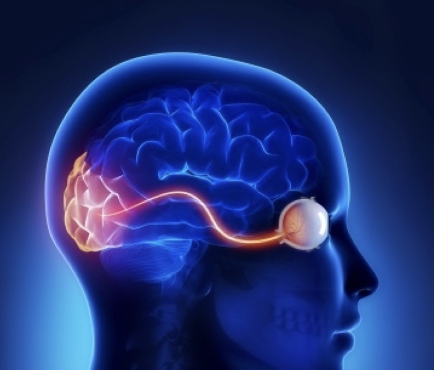 glaucoma