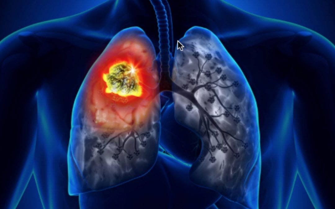Speciale Asco 2022 – Cabozantinib, risultati incoraggianti in monoterapia e in combinazione in diversi tipi di tumore tra cui il carcinoma del polmone metastatico