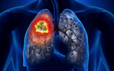 Speciale Asco 2022 – Cabozantinib, risultati incoraggianti in monoterapia e in combinazione in diversi tipi di tumore tra cui il carcinoma del polmone metastatico