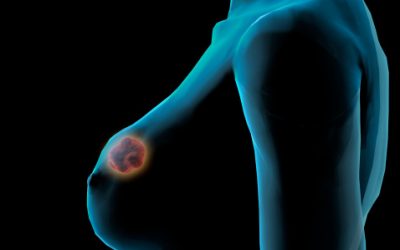 Asco 2022, tumore della mammella: la ricerca italiana in prima linea nel mondo