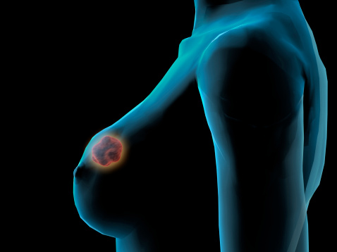 Asco 2022, tumore della mammella: la ricerca italiana in prima linea nel mondo
