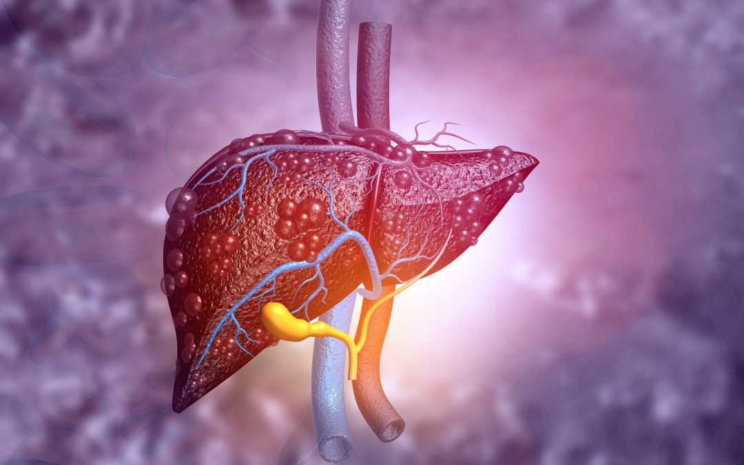 Tumore del fegato: anticipare l’immunoterapia riduce il rischio di un peggioramento